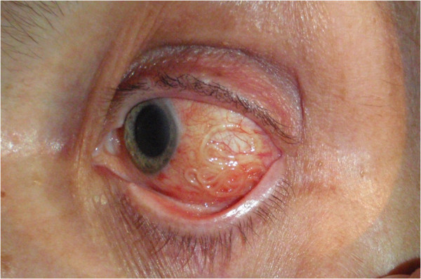 глаз паразит нематода болезнь